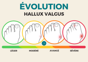 échelle évolution de l'hallux valgus
