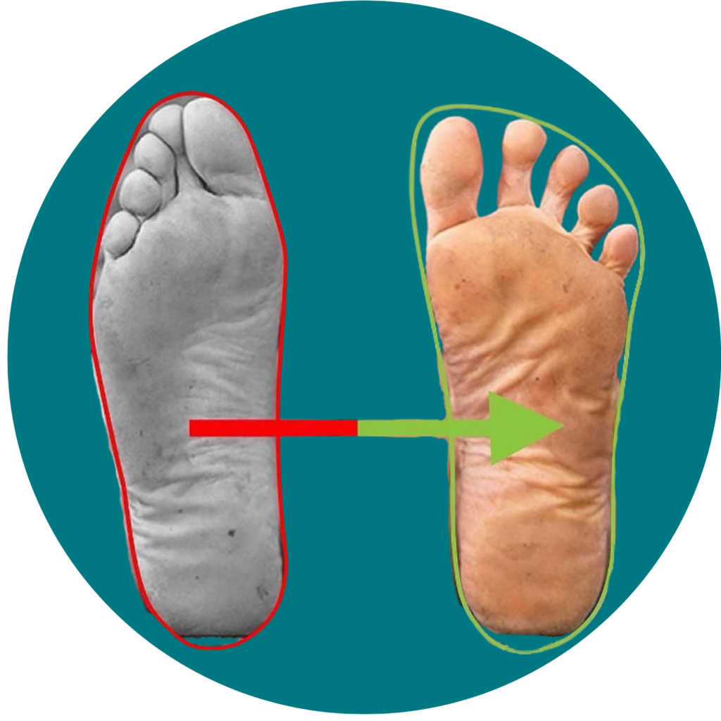 hallux valgus conseils